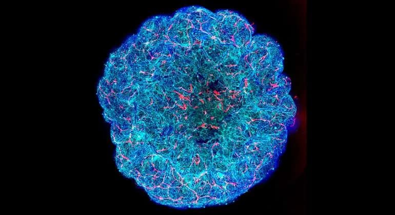 Identifican un mecanismo que daña los vasos sanguíneos en la enfermedad de Alzheimer